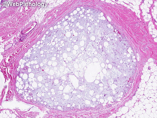 Soft Tissue_Lipomatous_Lipoblastoma23_resized.jpg